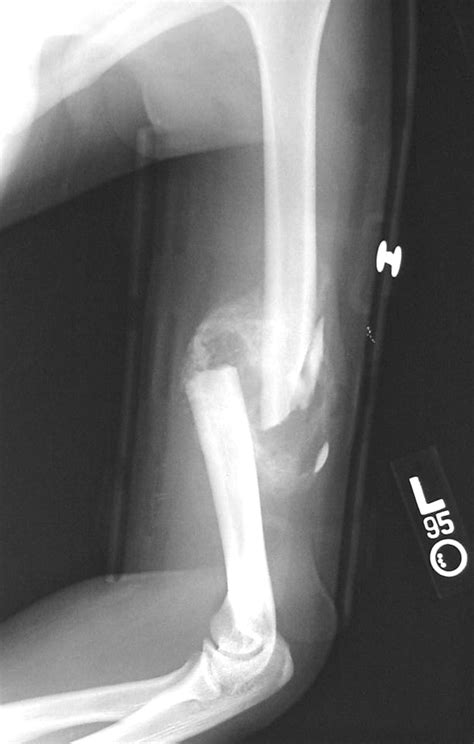 humerus fracture statistics ncbi